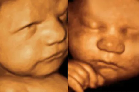 Pregnancy Sonography Test Pune