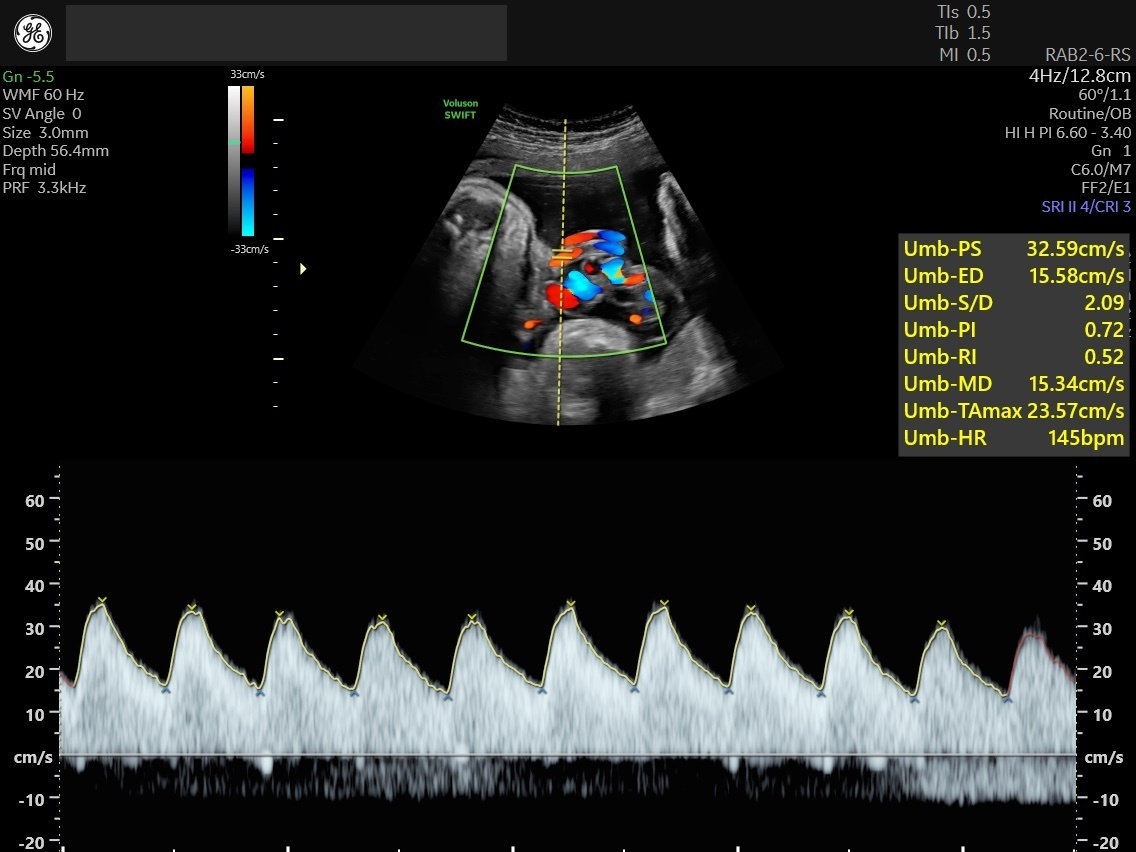 doppler-scan